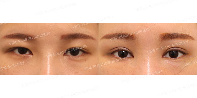 #절개눈매교정(재수술) #내시경이마거상