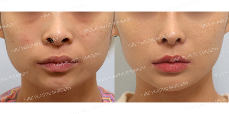 #얼굴지방이식 #심부볼지방제거 #비공내리기 #비주성형 #콧볼축소