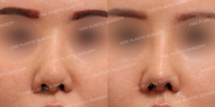 #코재수술 #복코 #짧은코