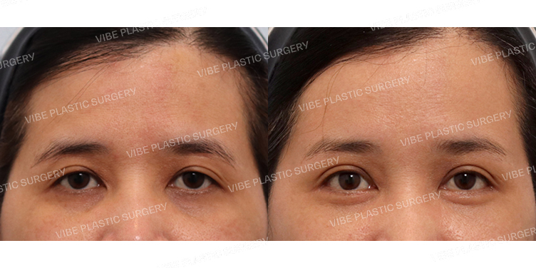 #비절개눈매교정 #뒤트임 #밑트임 #하안검 #내시경이마거상