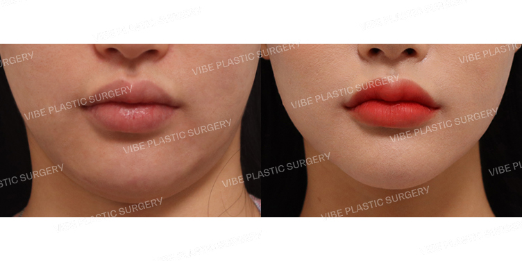 #초음파지방흡입(이중턱,턱라인) #실리프팅