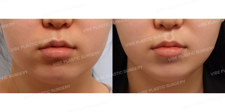 #초음파지방흡입(이중턱,턱라인)