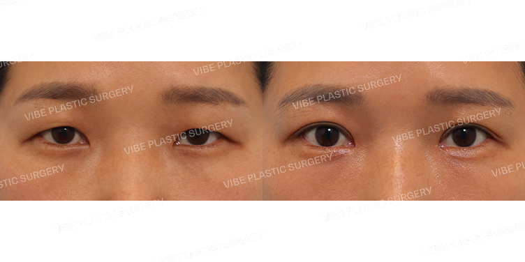 #상안검 #눈매교정 #앞트임