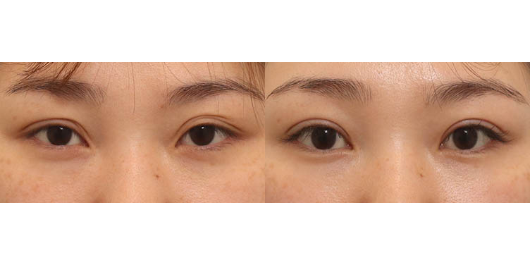 #절개쌍꺼풀(겹주름)