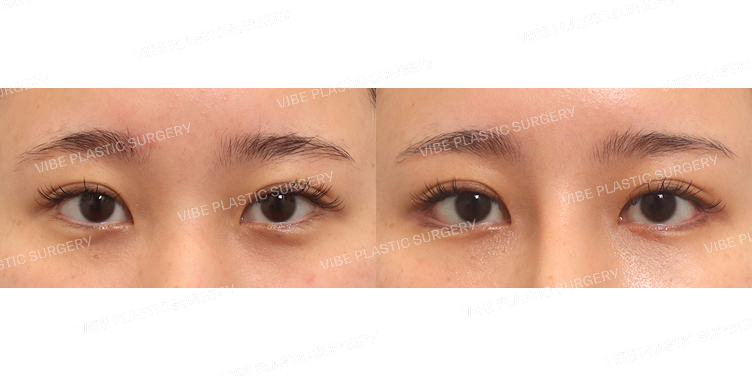 #뒤트임(재수술) #밑트임