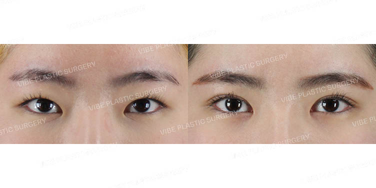 #부분절개 #앞트임