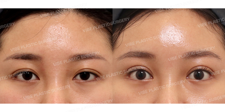 #내시경이마거상 #부분절개눈매교정