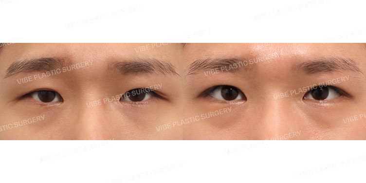 #남자무쌍눈매교정(재수술)