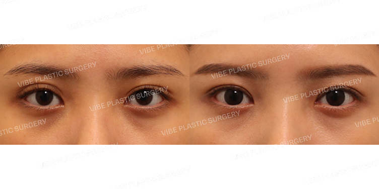 #절개쌍꺼풀(재수술) #눈두덩이지방재배치