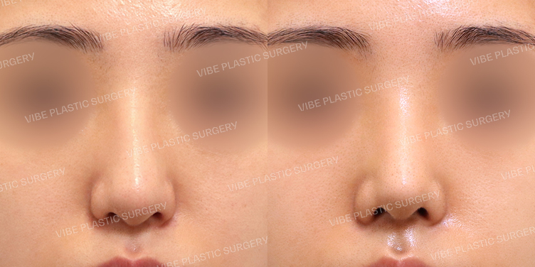 #무보형물 #매부리코 #복코 #긴코 #휜코