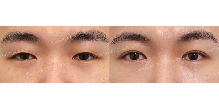 #비절개눈매교정 #앞트임