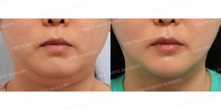 #초음파지방흡입(이중턱,턱라인) #턱끝필러