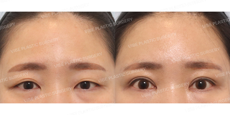 #내시경이마거상 #부분절개쌍꺼풀