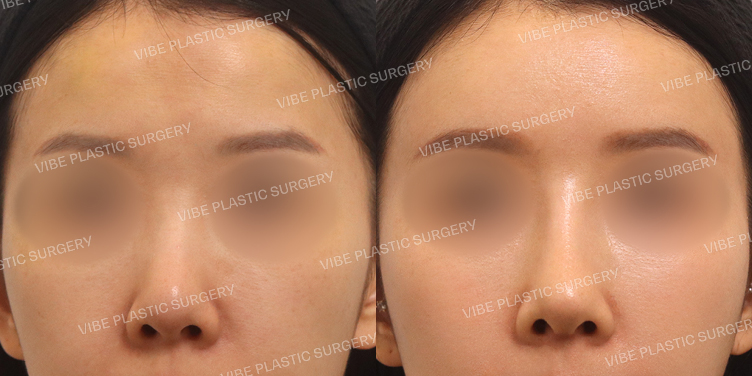 #이마지방이식 #짧은코