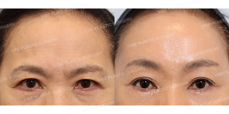 #내시경이마거상 #하안검(재수술)