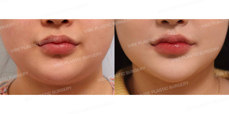 #리포사운드지방흡입(이중턱,턱라인)