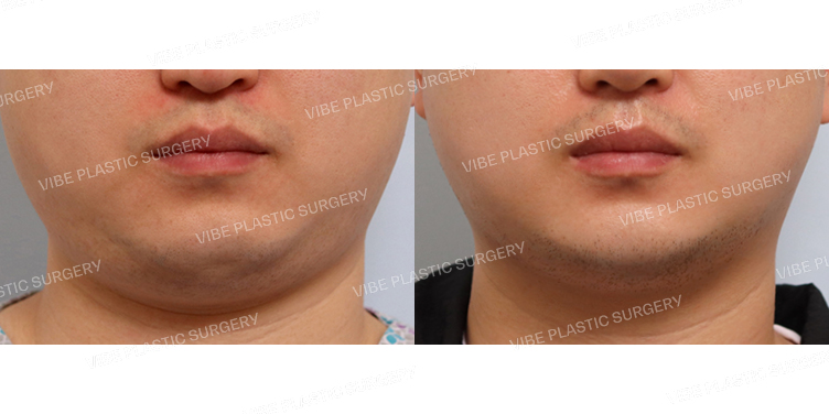 #초음파지방흡입(이중턱,턱라인)