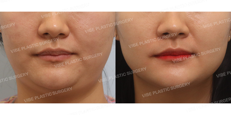 #초음파지방흡입(이중턱,턱라인)