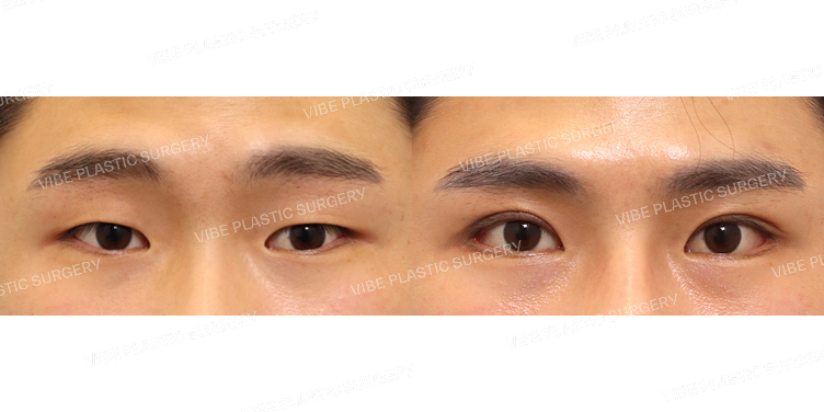 #절개눈매교정 #뒤트임 #밑트임