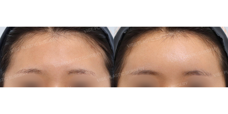 #지방이식(이마)