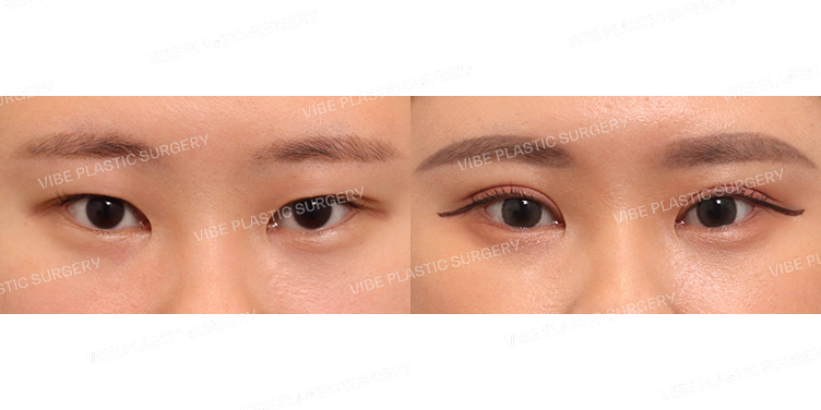 #절개눈매교정(재수술)