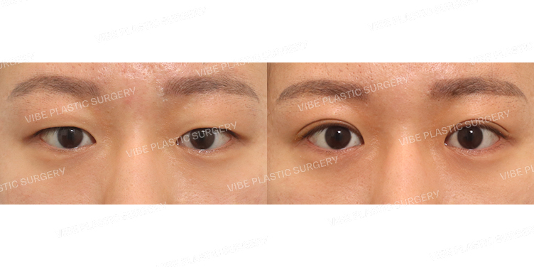 #부분절개쌍꺼풀