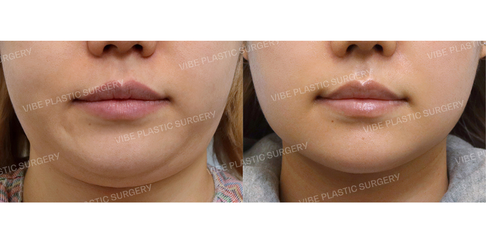 #초음파지방흡입(이중턱,턱라인) #심부볼지방제거