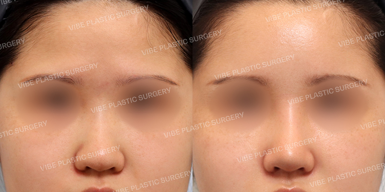 #지방이식(이마,관자) #콧대 #복코 #이물질제거