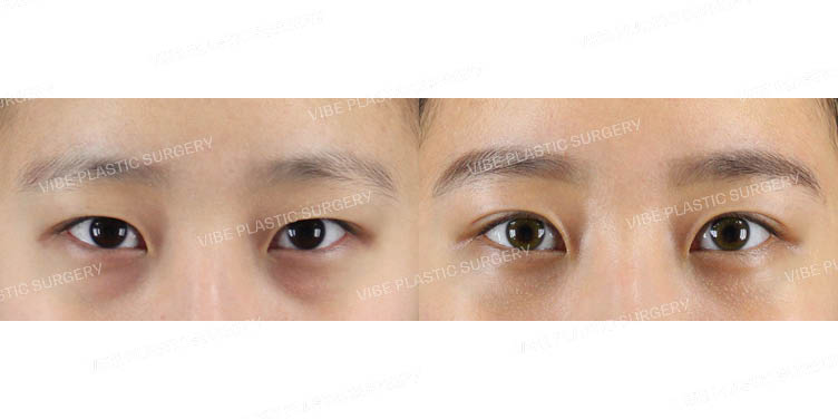 #자연유착 #눈밑지방재배치