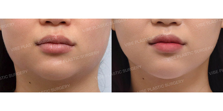 #초음파지방흡입(이중턱,턱라인) #사각턱보톡스 #슈링크