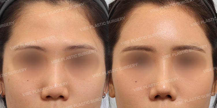 #복코 #짧은코 #이마지방이식