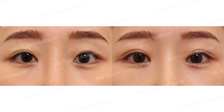 #자연유착(재수술)