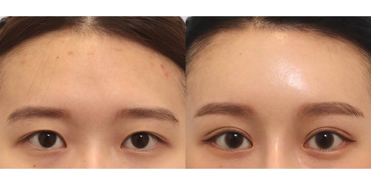 #내시경이마거상 #절개쌍꺼풀(재수술) #뒤트임 #밑트임