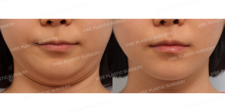 #초음파지방흡입(이중턱,턱라인)