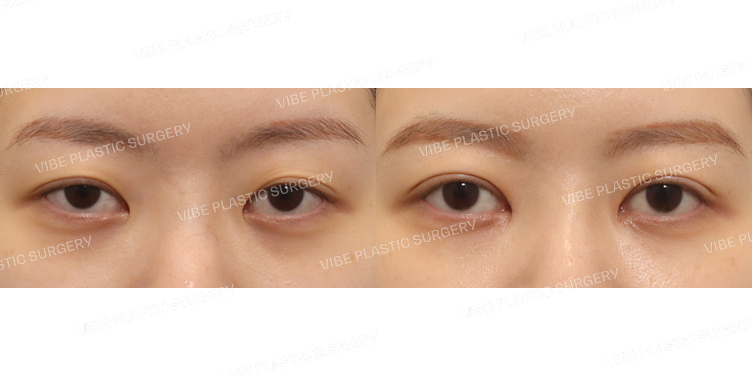 #비절개눈매교정(재수술) #앞트임