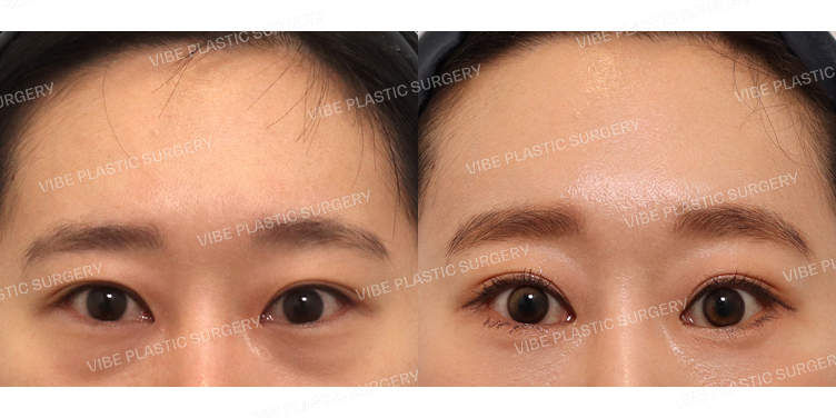 #내시경이마거상 #하안검