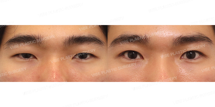 #절개쌍꺼풀(재수술)