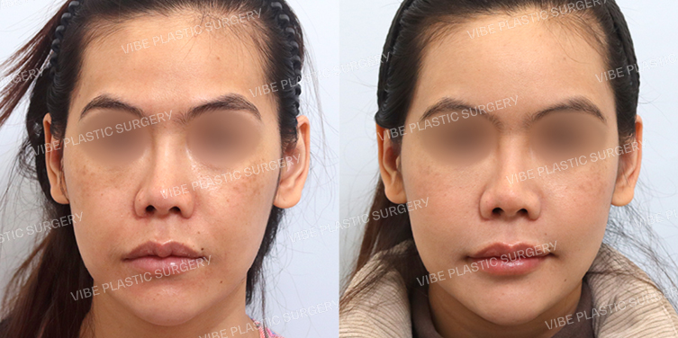 #풀페이스지방이식