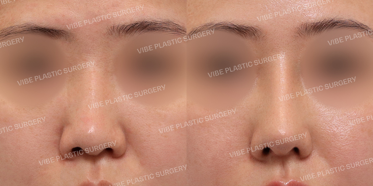 #기능코 #낮은코 #매부리코 #복코