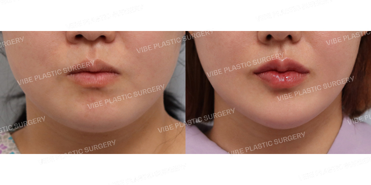 #초음파지방흡입(이중턱,턱라인)