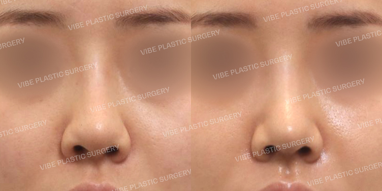 #복코 #짧은코(재수술)