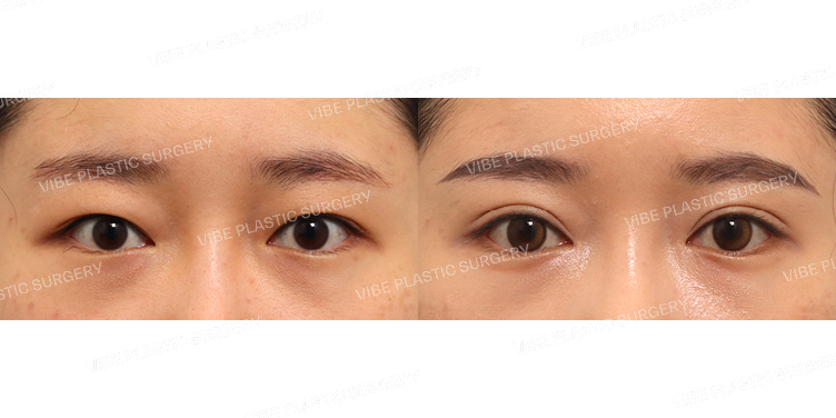 #절개쌍꺼풀(재수술)