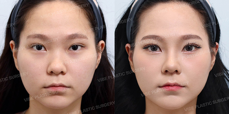 #콧대 #코끝 #복코 #비중격