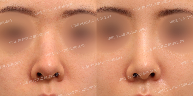 #매부리코 #복코 #비공교정