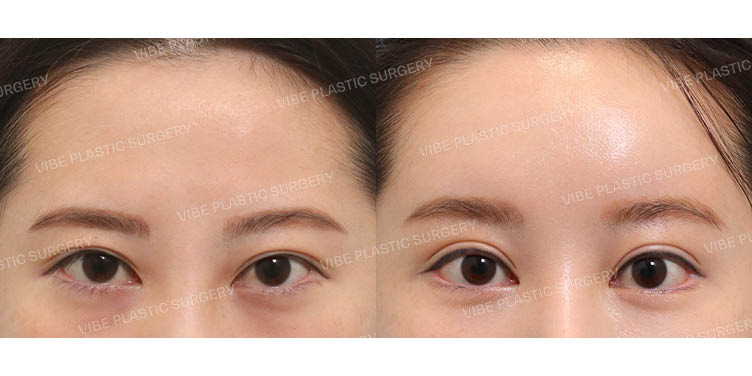 #이마지방이식 #내시경이마거상 #절개눈매교정(재수술) #뒤밑트임(재수술)