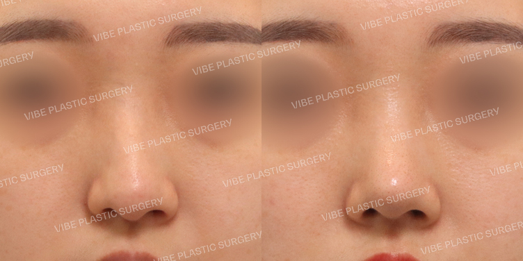 #휜코 #매부리코 #기능코