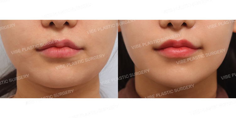 #초음파지방흡입(이중턱,턱라인)