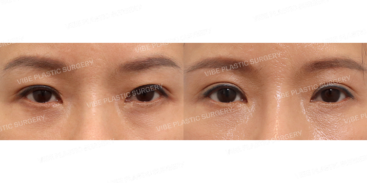 #눈썹밑거상 #자연유착(재수술)