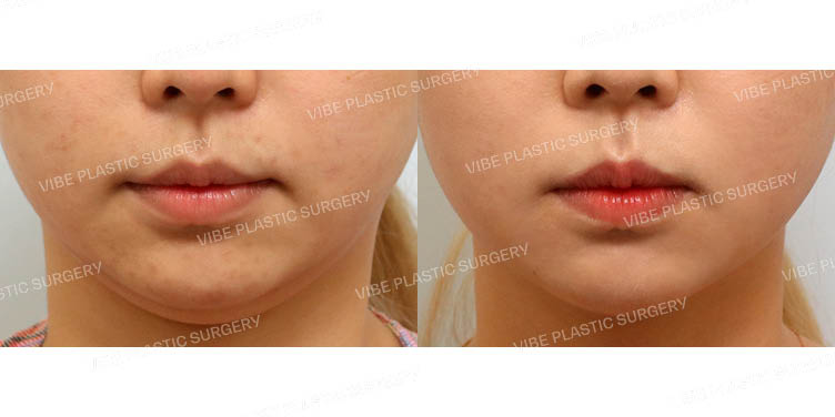 #이중턱지방흡입