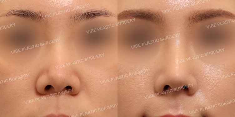 #코재수술 #복코 #휜코